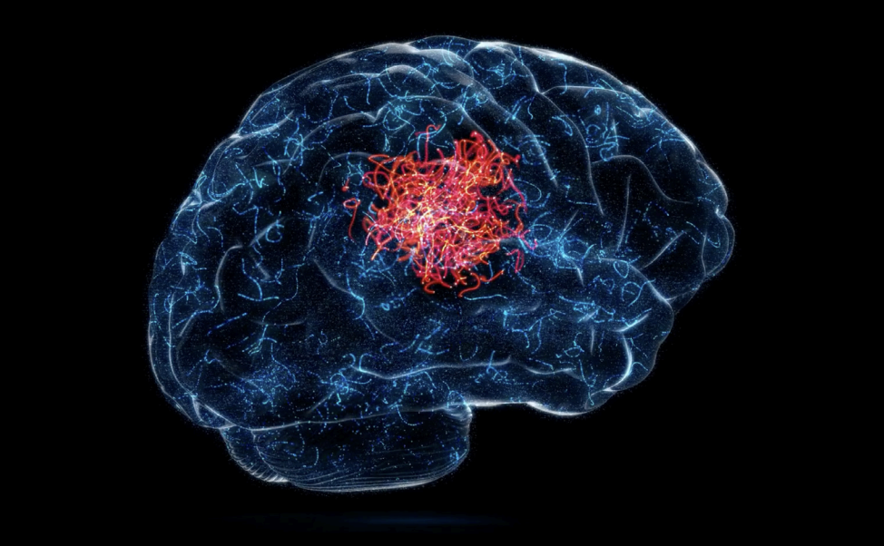 Memory Loss and Local Brain Health Research